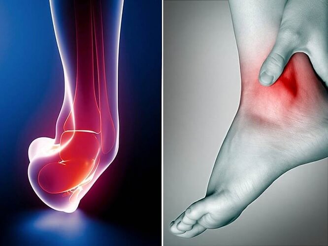 Home Remedies for Ankle Sprain Pain